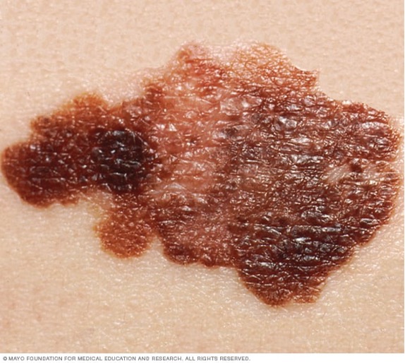 Melanoma