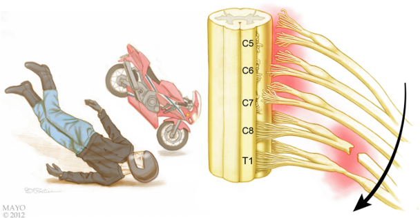 Brachial Plexus-Associated Injuries | SpringerLink