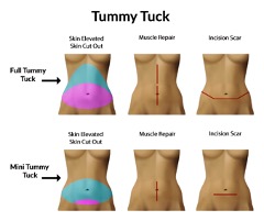 Choosing a Full or Mini Tummy Tuck – Which One is Best for You