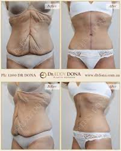 fleur de lis tummy tuck - Online Discount Shop for Electronics, Apparel,  Toys, Books, Games, Computers, Shoes, Jewelry, Watches, Baby Products,  Sports & Outdoors, Office Products, Bed & Bath, Furniture, Tools, Hardware,