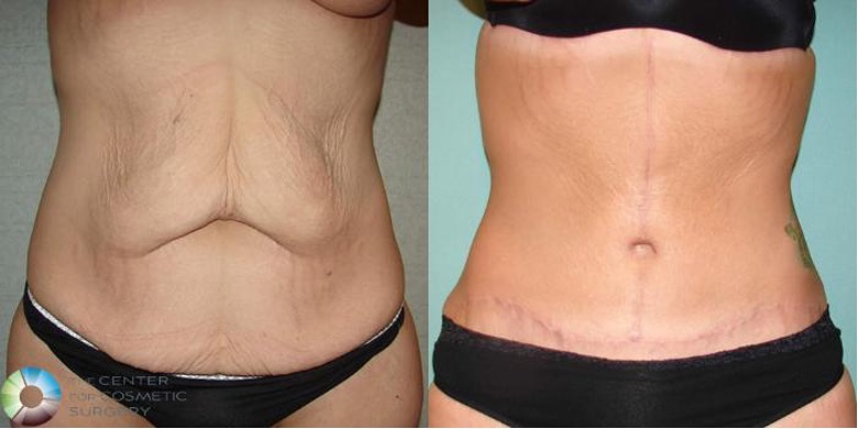 Arm Lift Before and After Pictures Case 508 | Golden, CO | The Center for  Cosmetic Surgery