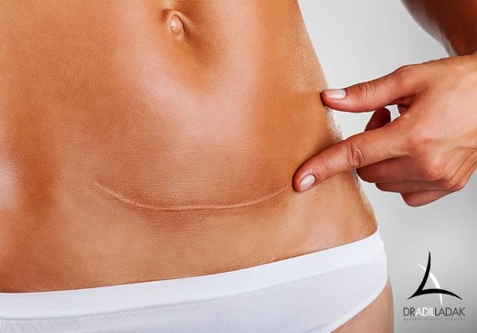 5 Tips To Minimize Tummy Tuck Scars | Edmonton-Plastic Surgeon