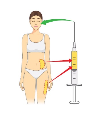 Fat injection in Iran| Fat transfer & Fat grafting cost in Iran|  TebMedTourism